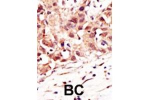 Formalin-fixed and paraffin-embedded human cancer tissue reacted with the primary antibody, which was peroxidase-conjugated to the secondary antibody, followed by DAB staining. (SENP5 Antikörper  (C-Term))