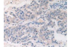 IHC-P analysis of Human Breast Cancer Tissue, with DAB staining. (FDFT1 Antikörper  (AA 269-417))