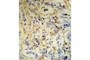 FGA Antibody (RB18707) IHC analysis in formalin fixed and paraffin embedded human breast carcinoma tissue followed by peroxidase conjugation of the secondary antibody and DAB staining. (FGA Antikörper  (N-Term))