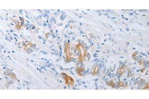 Immunohistochemistry of paraffin-embedded Human gastric cancer using LOX Polyclonal Antibody at dilution of 1:30 (LOX Antikörper)