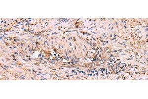 Immunohistochemistry of paraffin-embedded Human cervical cancer tissue using MAPK8IP3 Polyclonal Antibody at dilution of 1:45(x200) (JIP3 Antikörper)