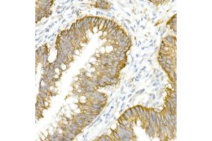 Immunohistochemistry of paraffin-embedded human colon carcinoma using SLC12 Rabbit pAb (ABIN6131136, ABIN6147843, ABIN6147844 and ABIN6215366) at dilution of 1:50 (40x lens). (SLC12A2 Antikörper  (AA 120-280))