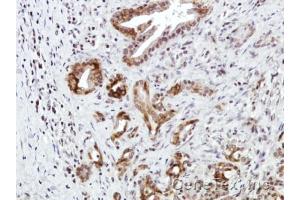 IHC-P Image Immunohistochemical analysis of paraffin-embedded Human pancreatic tumor, using CXCR7, antibody at 1:100 dilution. (CXCR7 Antikörper)