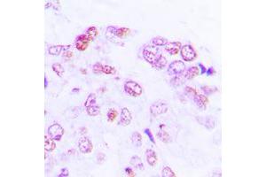 Immunohistochemical analysis of ATF2 staining in human lung cancer formalin fixed paraffin embedded tissue section. (ATF2 Antikörper  (Center))