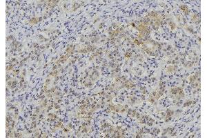 ABIN6276383 at 1/100 staining Human lung cancer tissue by IHC-P. (WNT3A Antikörper  (Internal Region))