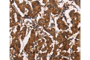 Immunohistochemistry of Human thyroid cancer using ATRN Polyclonal Antibody at dilution of 1:50 (Attractin Antikörper)
