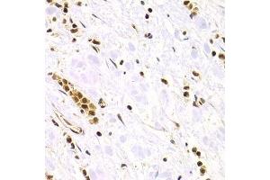Immunohistochemistry of paraffin-embedded human gastric cancer using RAD50 Antibody. (RAD50 Antikörper)