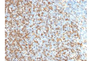Formalin-fixed, paraffin-embedded human Follicular Lymphoma stained with LMO2 Mouse Monoclonal Antibody (LMO2/1971).