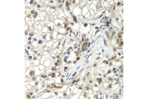 Immunohistochemistry of paraffin-embedded human kidney cancer using ASPSCR1 antibody (ABIN5975297) at dilution of 1/100 (40x lens). (ASPSCR1 Antikörper)