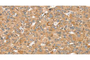 Immunohistochemistry of paraffin-embedded Human liver cancer using MORF4L1 Polyclonal Antibody at dilution of 1:35 (MORF4L1 Antikörper)