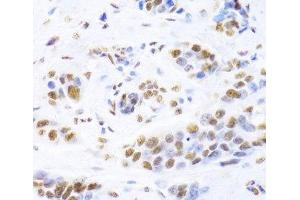 Immunohistochemistry of paraffin-embedded Human breast cancer using XRCC5 Polyclonal Antibody at dilution of 1:100 (40x lens). (XRCC5 Antikörper)