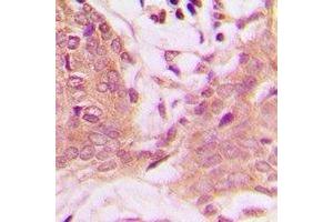 Immunohistochemical analysis of PEA15 (pS116) staining in human breast cancer formalin fixed paraffin embedded tissue section. (PEA15 Antikörper  (C-Term, pSer116))