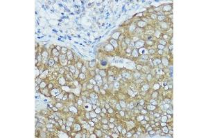 Immunohistochemistry of paraffin-embedded human breast cancer using BSCL2 antibody (ABIN7265874) at dilution of 1:100 (40x lens).