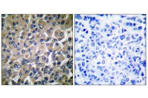 Immunohistochemical analysis of paraffin-embedded human breast carcinoma tissue, using GRP78 antibody (ABIN5976417). (GRP78 Antikörper  (C-Term))