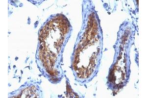 Formalin-fixed, paraffin-embedded human Testicular Carcinoma stained with MVP Monoclonal Antibody (SPM280). (MVP Antikörper)