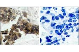 Immunohistochemistry analysis of paraffin-embedded human breast carcinoma, using IkappaB-alpha (Phospho-Ser32/Ser36) Antibody.