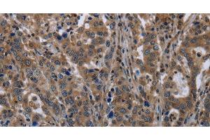Immunohistochemistry of paraffin-embedded Human liver cancer tissue using TSC22D3 Polyclonal Antibody at dilution 1:40 (TSC22D3 Antikörper)