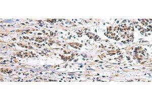 Immunohistochemistry of paraffin-embedded Human breast cancer tissue using CLCN7 Polyclonal Antibody at dilution of 1:105(x200) (CLCN7 Antikörper)
