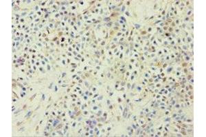Immunohistochemistry of paraffin-embedded human breast cancer using ABIN7144925 at dilution of 1:100 (ABCF2 Antikörper  (AA 1-250))