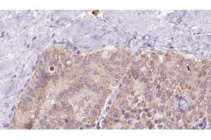 ABIN6273340 at 1/100 staining Human thyroid cancer tissue by IHC-P. (UQCRQ Antikörper  (Internal Region))