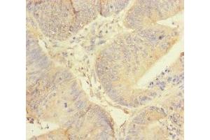 Immunohistochemistry of paraffin-embedded human colon cancer using ABIN7167451 at dilution of 1:100 (REEP5 Antikörper  (AA 120-189))