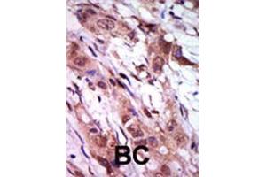 Formalin-fixed and paraffin-embedded human cancer tissue reacted with the primary antibody, which was peroxidase-conjugated to the secondary antibody, followed by AEC staining. (Aurora Kinase C Antikörper  (C-Term))