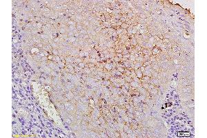 Formalin-fixed and paraffin human laryngocarcinoma labeled with Anti-CD44V10 Polyclonal Antibody, Unconjugated at 1:200, followed by conjugation to the secondary antibody and DAB staining. (CD44v10 (AA 218-227) Antikörper)