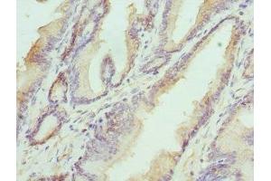 Immunohistochemistry of paraffin-embedded human prostate cancer using ABIN7155947 at dilution of 1:100 (HAPLN1 Antikörper  (AA 165-354))