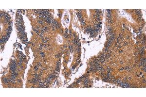 Immunohistochemistry of paraffin-embedded Human colon cancer using SEPT7 Polyclonal Antibody at dilution of 1:50 (Septin 7 Antikörper)