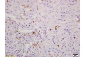 Formalin-fixed and paraffin embedded human lung carcinoma labeled with Rabbit Anti CD79A/IGBP-1 Polyclonal Antibody, Unconjugated (ABIN727578) at 1:200 followed by conjugation to the secondary antibody and DAB staining