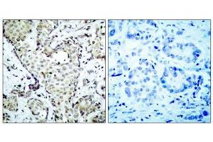 Immunohistochemical analysis of paraffin-embedded breast carcinoma, using MKK6 (epitope around residue 207) Antibody (ABIN5976227).