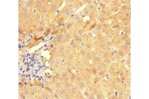 Immunohistochemistry of paraffin-embedded human liver cancer using ABIN7154281 at dilution of 1:100 (GMPR Antikörper  (AA 1-345))