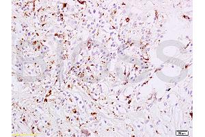 Formalin-fixed and paraffin embedded human liver carcinoma tissue labeled with Anti-phospho-STAT6(Tyr641) Polyclonal Antibody, Unconjugated (ABIN734483) at 1:200 followed by conjugation to the secondary antibody, (SP-0023), and DAB staining (STAT6 Antikörper  (pTyr641))