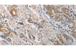Immunohistochemistry of paraffin-embedded Human gastic cancer using CST3 Polyclonal Antibody at dilution of 1:50 (CST3 Antikörper)