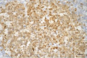 Immunohistochemistry was performed on paraffin-embedded human tonsillitis using caspase 3 antibody (ABIN7797894), 1:100).