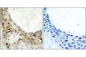 Immunohistochemistry analysis of paraffin-embedded human breast carcinoma, using BCL-2 (Phospho-Ser70) Antibody. (Bcl-2 Antikörper  (pSer70))