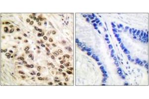 Immunohistochemistry analysis of paraffin-embedded human lung carcinoma tissue, using C/EBP-beta (Ab-235/188) Antibody. (CEBPB Antikörper  (AA 201-250))