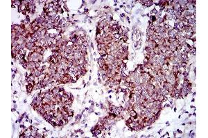 Immunohistochemical analysis of paraffin-embedded breast cancer tissues using MRPL42 mouse mAb with DAB staining. (MRPL42 Antikörper  (AA 10-142))