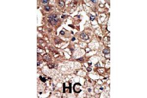 Formalin-fixed and paraffin-embedded human hepatocellular carcinoma tissue reacted with EPS8 polyclonal antibody  , which was peroxidase-conjugated to the secondary antibody, followed by DAB staining. (EPS8 Antikörper  (N-Term))