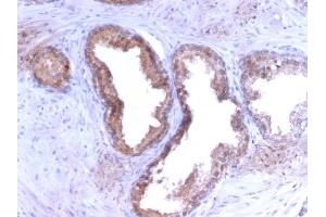 Formalin-fixed, paraffin-embedded human Prostate Carcinoma stained with PSA Rabbit Recombinant Monoclonal Antibody (KLK3/2871R). (Rekombinanter Prostate Specific Antigen Antikörper)