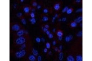 Immunofluorescence analysis of Human liver cancer tissue using CD45 Monoclonal Antibody at dilution of 1:200. (CD45 Antikörper)