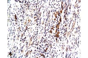 Formalin-fixed and paraffin embedded human colon carcinoma with Anti-Maspin Polyclonal Antibody, Unconjugated at 1:200, followed by conjugation to the secondary antibody and DAB staining (SERPINB5 Antikörper  (AA 301-375))