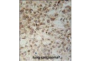 C14orf179 Antibody (Center) (ABIN651563 and ABIN2840304) immunohistochemistry analysis in formalin fixed and paraffin embedded human lung carcinoma followed by peroxidase conjugation of the secondary antibody and DAB staining. (IFT43 Antikörper  (AA 145-171))