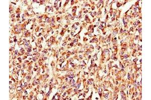 Immunohistochemistry of paraffin-embedded human melanoma using ABIN7158215 at dilution of 1:100 (LSMEM1 Antikörper  (AA 1-131))