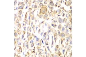 Immunohistochemistry of paraffin-embedded human lung cancer using CD151 antibody (ABIN3023660, ABIN3023661, ABIN3023662, ABIN1679069 and ABIN6219074) at dilution of 1:200 (40x lens). (CD151 Antikörper  (AA 113-221))