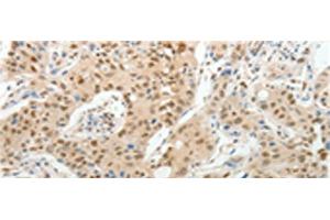 Immunohistochemistry of paraffin-embedded Human lung cancer tissue using UNC5CL Polyclonal Antibody at dilution of 1:50(x200)