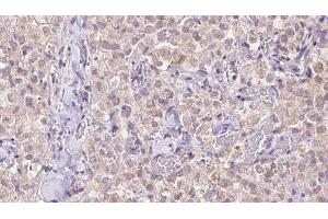 ABIN6273343 at 1/100 staining Human thyroid cancer tissue by IHC-P.