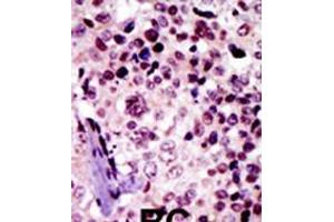 Formalin-fixed and paraffin-embedded human cancer tissue reacted with the primary antibody, which was peroxidase-conjugated to the secondary antibody, followed by AEC staining. (Protein Kinase A beta (AA 50-80), (N-Term), (Regulatory Subunit 1) Antikörper)