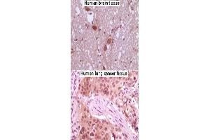 Immunohistochemical analysis of paraffin-embedded human brain tissue and lung carcinoma tissue, showing nuclear/cytoplasmic localization using MAPK10 monoclonal antibody, clone 8A5D11  with DAB staining. (MAPK10 Antikörper)