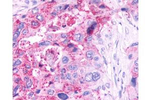 Anti-GPR61 antibody IHC of human Pancreas, Carcinoma.